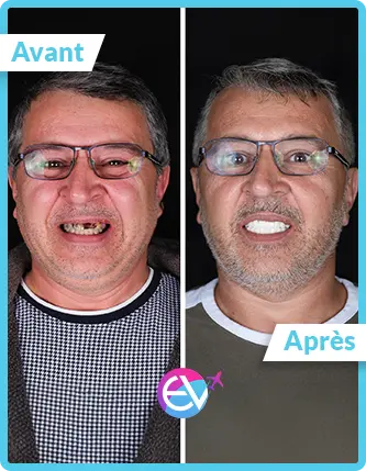 Photo couronne dentaire avant/après 2