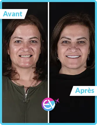 Photo facette dentaire avant/après 5