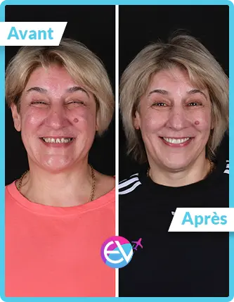 Photo facette dentaire avant/après 4