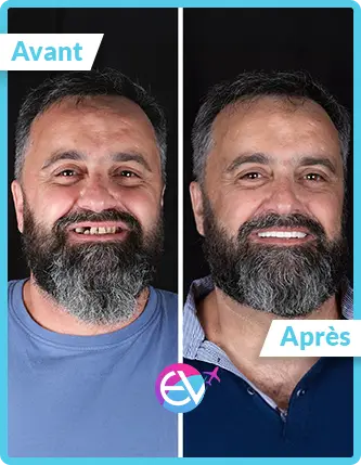 Photo implant dentaire avant/après 2