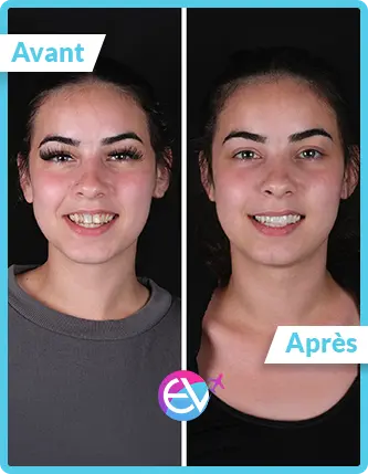 Photo couronne dentaire avant/après 5