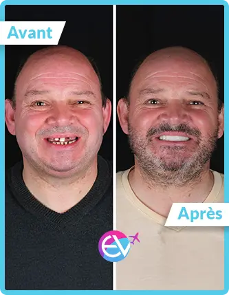 Photo implant dentaire avant/après 4