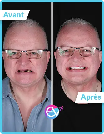 Photo implant dentaire avant/après 5