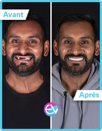 Photo implant dentaire avant/après 8