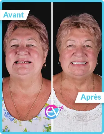 Photo implant dentaire avant/après