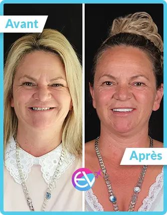 Photo blanchiment dentaire avant/après 6