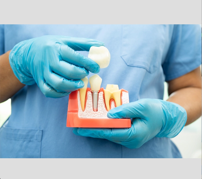 Couronne dentaire pas cher